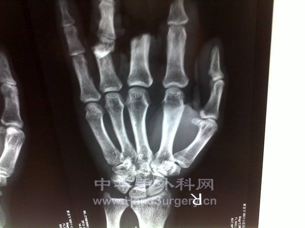 术前X片