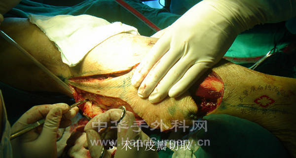 3.皮瓣切取