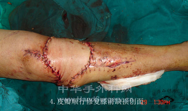 4.皮瓣修复即刻