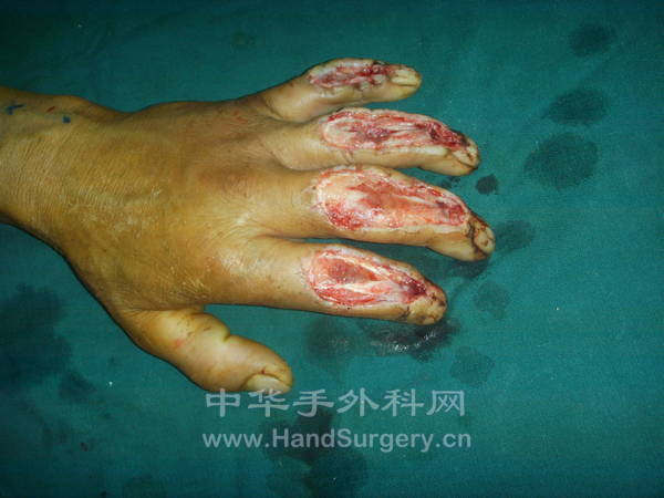 多指皮肤缺损