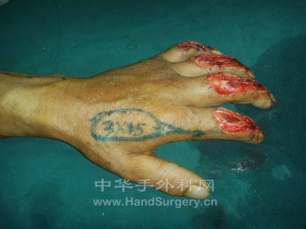 食指桡侧皮神经营养血管皮瓣修复