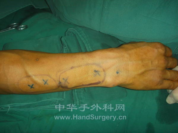 前臂一区二瓣设计