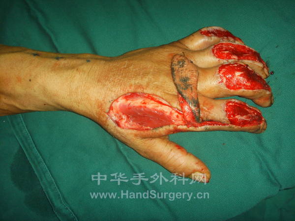 食指带蒂皮瓣的切取