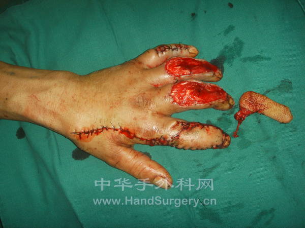 第一穿支皮瓣游离后