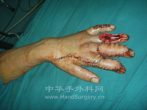 中指皮瓣血管吻合后