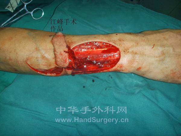 第一个穿支皮瓣切取