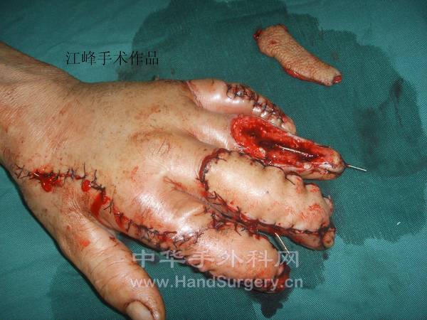 第二个穿支皮瓣切取修复前