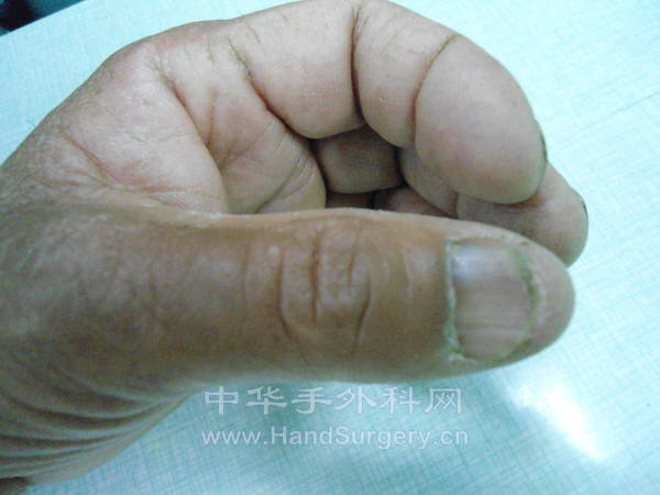 术前，拇指指甲尺侧发蓝，疼痛是相当的严重啊！