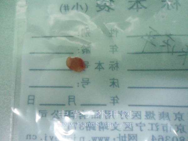 术后：剥离的血管球瘤。