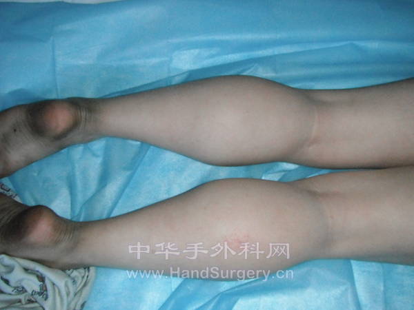 肿胀情况
