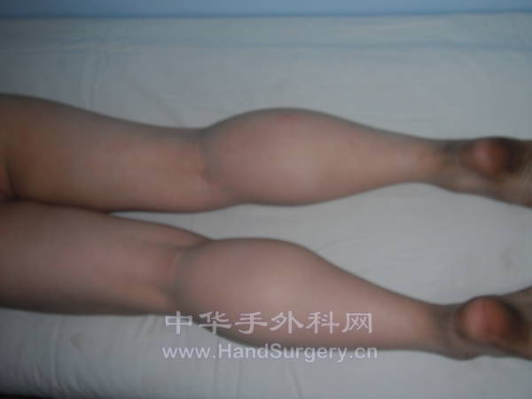肿胀情况