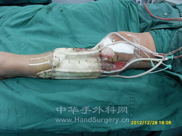 VSD术后
