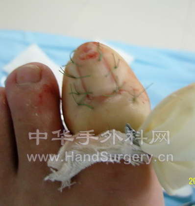 缝合后.jpg