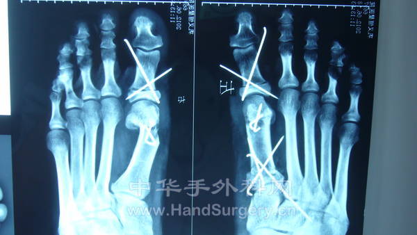 术后X光