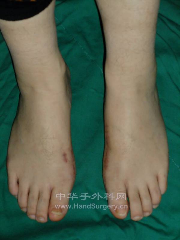 术后4个月