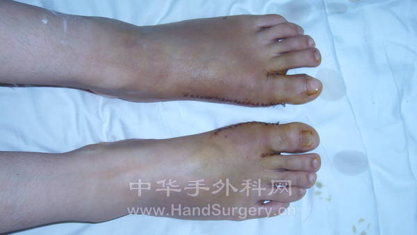 术后一周