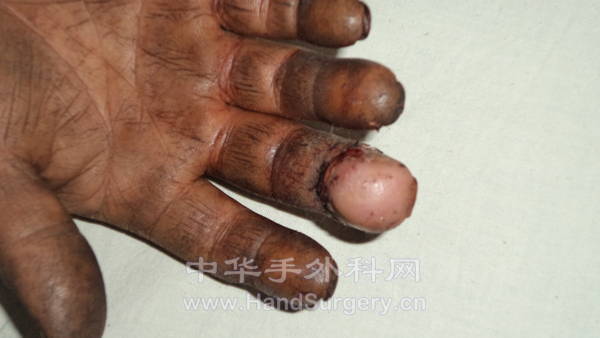 术后