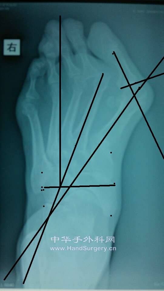 依此片可见HAA60度，IMA15度，PASA35度123跖骨内翻第二跖骨内翻角20度，踇趾有外旋畸形，第二跖趾关节半脱 ...