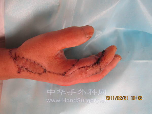 拆线之后