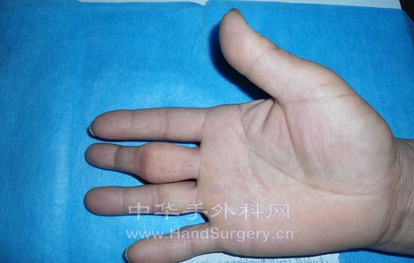 掌侧，可见中指近侧指间关节粗大，原伤口远端指体萎缩。