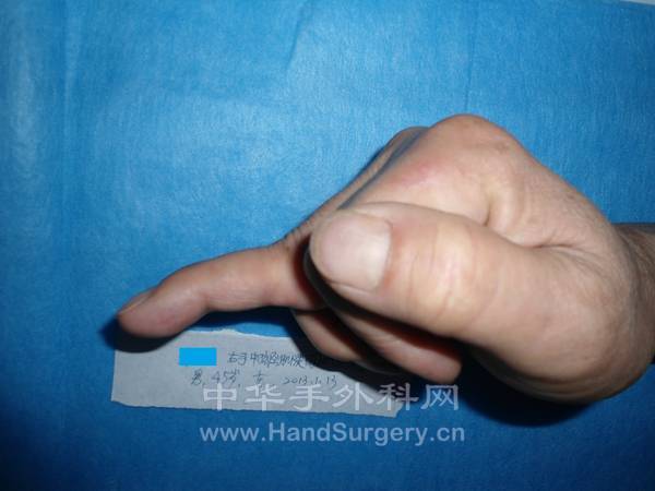五指屈曲位，桡侧观，可见中指屈曲不能，近侧指间关节反张。