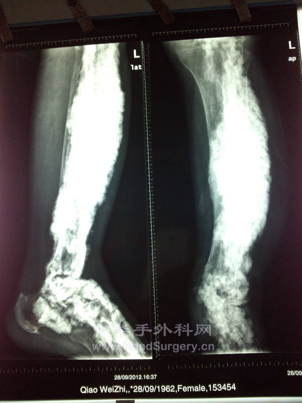 胫腓骨及踝关节X片