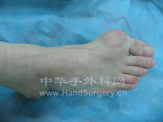 足趾与外踝.jpg