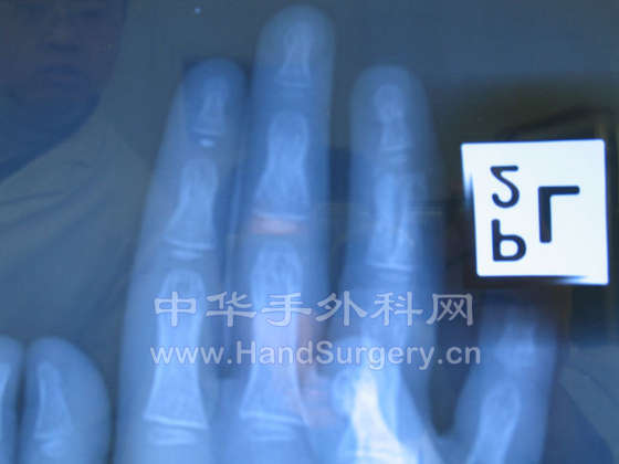 骨折X线片1.jpg