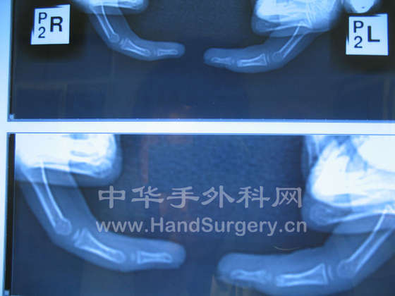 骨折X线片2.jpg