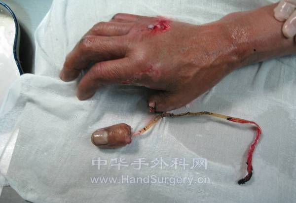 拇指旋转撕脱伤在当地医院给予清创缝合