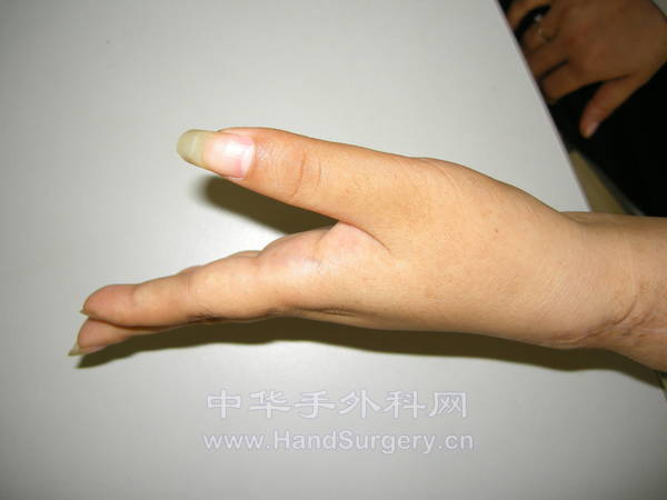 术后1年伸MP关节\伸腕恢复