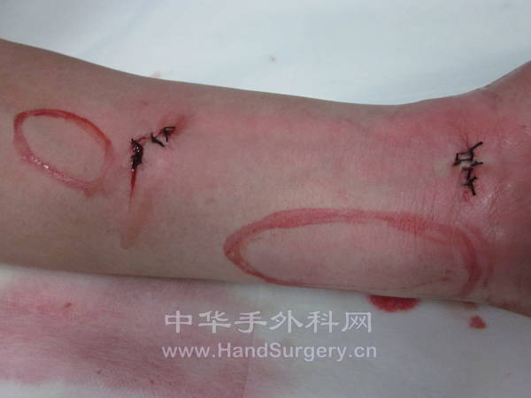 食指局转，中指游离腕上支皮瓣，环指游离静脉皮瓣