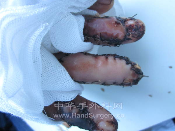 食指皮瓣有点失败，呵呵