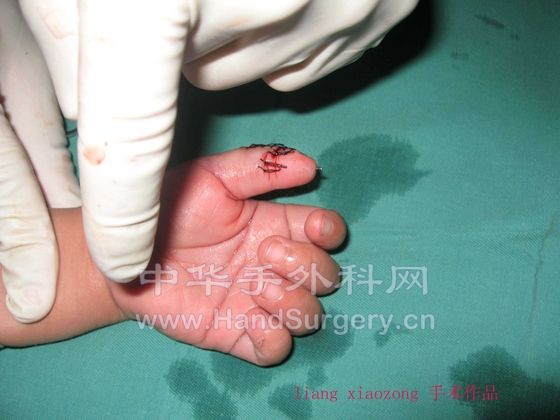 先天畸形术后