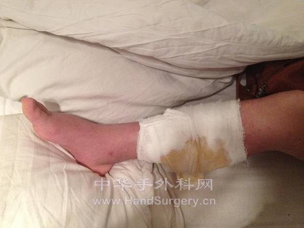 患者男性，三十一岁，因“有小腿肿胀2个月余入院。患者于两个月前无明显原因出现有小腿肿胀，逐渐加重，先 ...