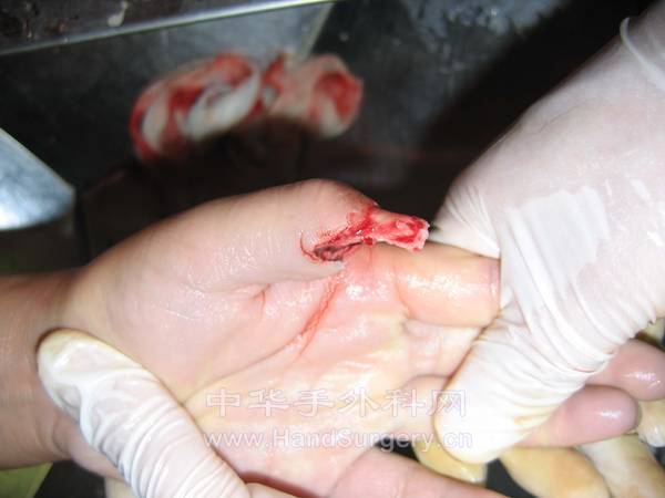 拇指伤后侧面观.jpg