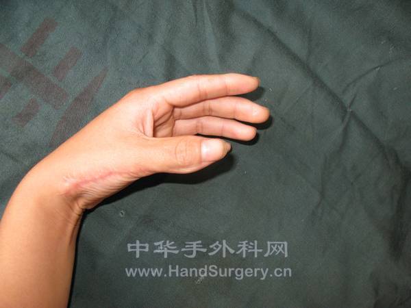拇指术后1年4个月背面观.jpg