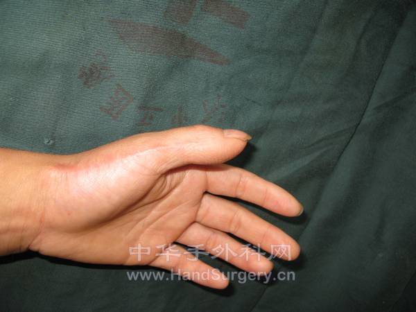 拇指术后1年4个月侧面观.jpg