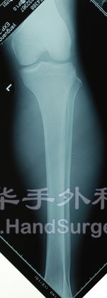 左小腿正位.jpg
