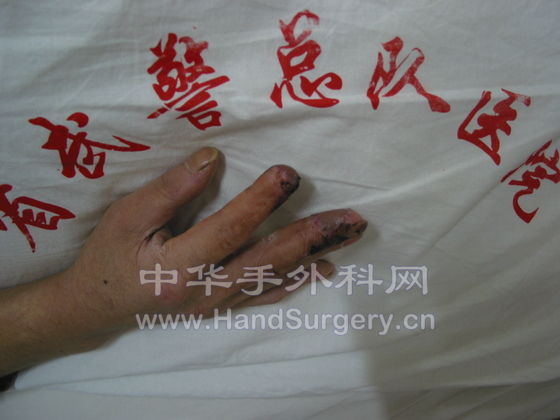腹部皮瓣术后2.JPG