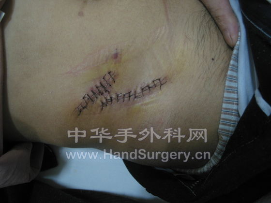 腹部皮瓣术后3.JPG