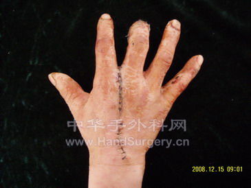 中指皮肤缺损术后十四天1.jpg