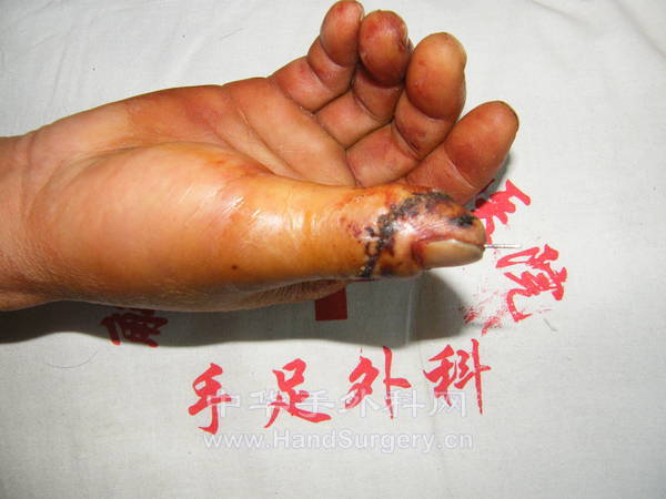 术后十四天 (7).JPG
