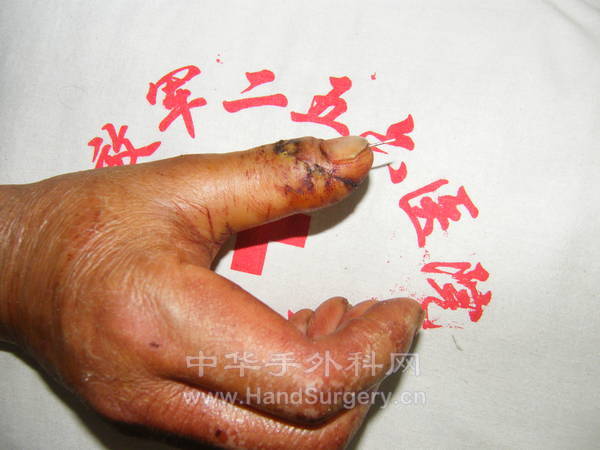 术后十四天 (6).JPG
