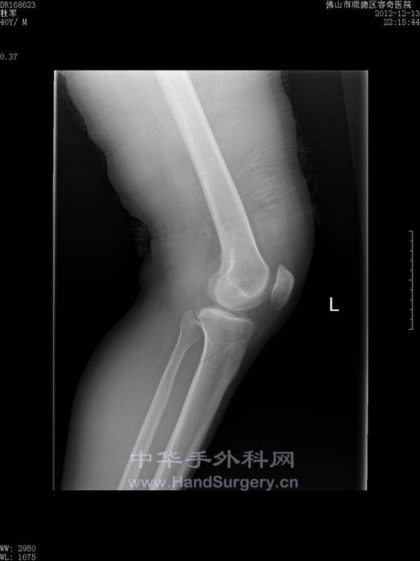 二分髌骨2.jpg