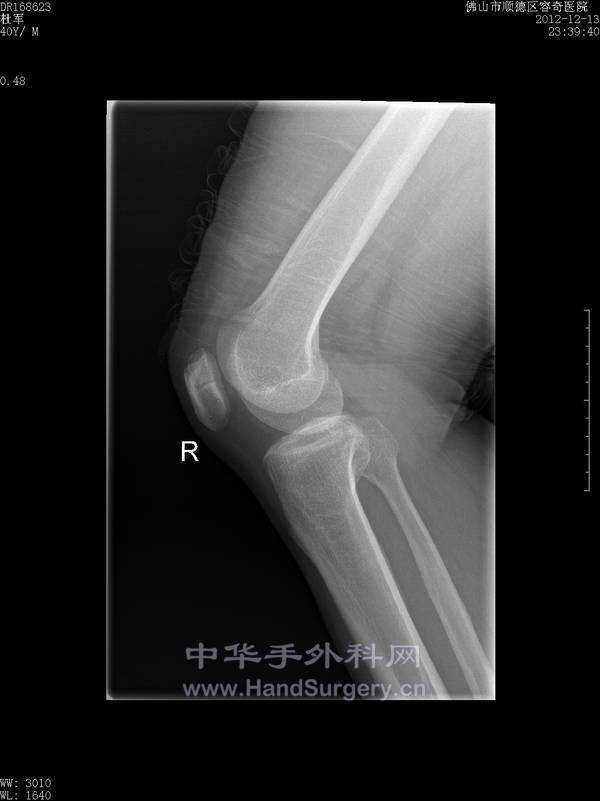 二分髌骨4.jpg