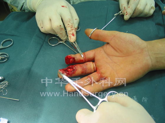 腹部皮瓣术前2.JPG