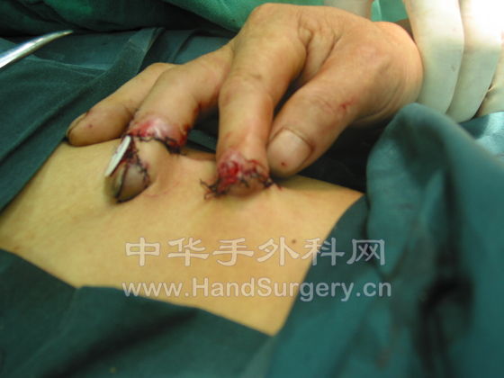 腹部皮瓣埋藏3.JPG
