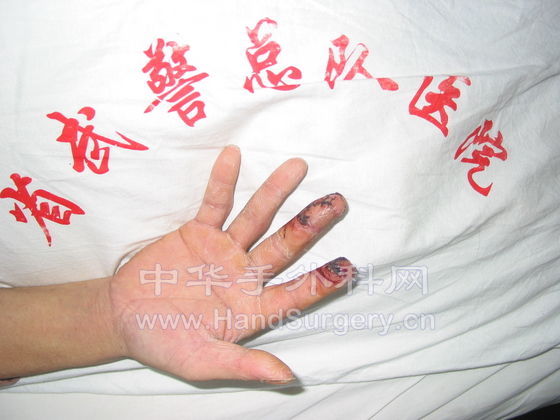 腹部皮瓣术后1.JPG