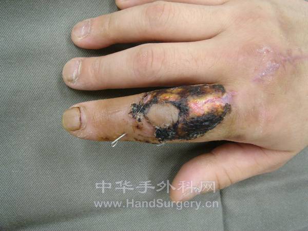 并节皮肤血供良好，值皮部分脱落